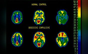 What Does An Ocd Brain Look Like? < Yale School Of Medicine