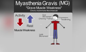 Featured Research Improving Treatment For Myasthenia Gravis